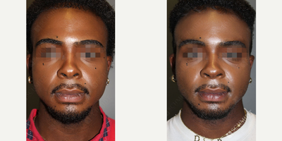 Buccal Fat Removal before and after photo