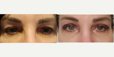 Eyelid Surgery before and after photo