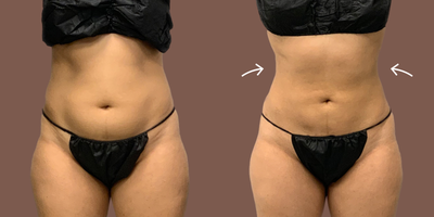 AirSculpt before and after photo