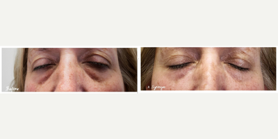 Eyelid Surgery before and after photo