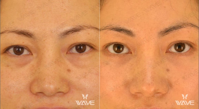 Eyelid Surgery before and after photo