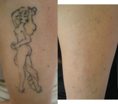 Tattoo Removal before and after photo