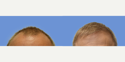 FUE Hair Transplant before and after photo