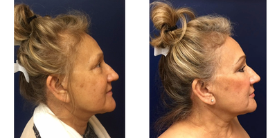 Juvederm before and after photo