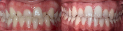 Braces before and after photo