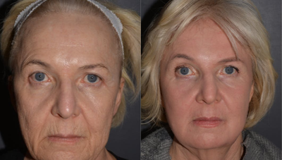 Chemical Peel before and after photo