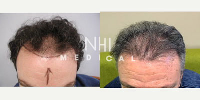 FUE Hair Transplant before and after photo