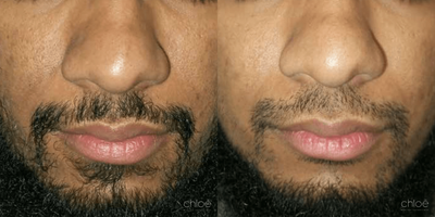 Skin Tightening before and after photo