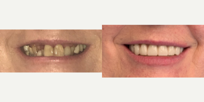 All-on-4 Dental Implants before and after photo