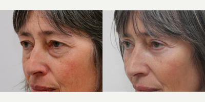 Eyelid Surgery before and after photo