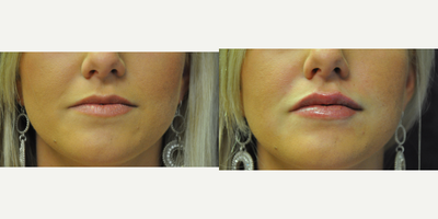 Juvederm before and after photo
