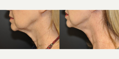 Neck Lift before and after photo