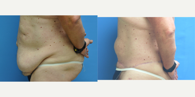 Panniculectomy before and after photo