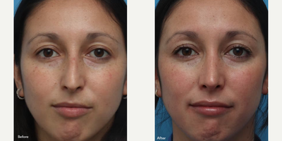 Rhinoplasty before and after photo