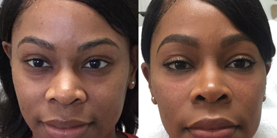 Vollure before and after photo