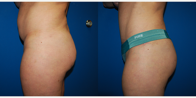 Brazilian Butt Lift before and after photo