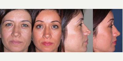 Brow Lift before and after photo