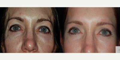 Eyelid Surgery before and after photo
