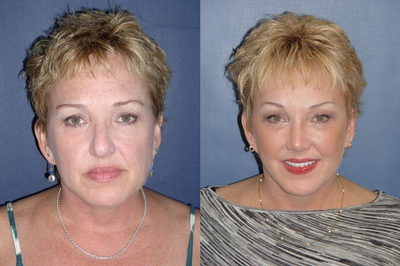 Facelift before and after photo