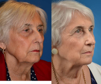 Neck Lift before and after photo