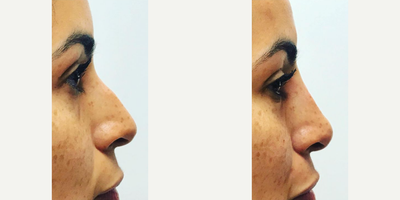 Nonsurgical Nose Job before and after photo