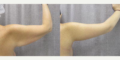 Arm Lift before and after photo
