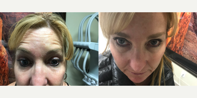 Botox before and after photo