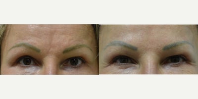 Botox before and after photo