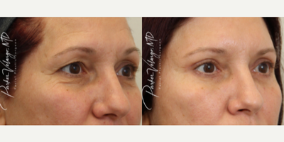 Brow Lift before and after photo