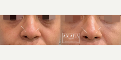 Dermal Fillers before and after photo