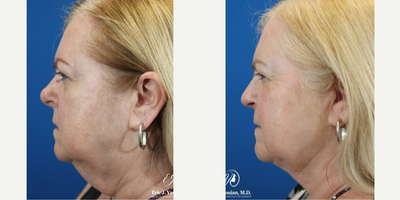 FaceTite before and after photo