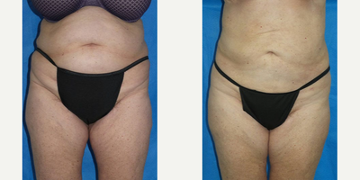Liposuction before and after photo