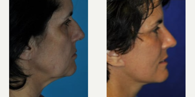 Neck Lift before and after photo