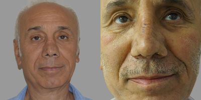 Revision Rhinoplasty before and after photo