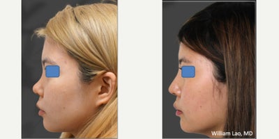 Rhinoplasty before and after photo