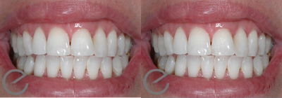Teeth Whitening before and after photo