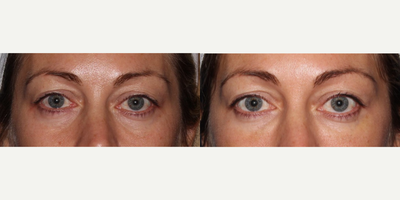 Belotero before and after photo