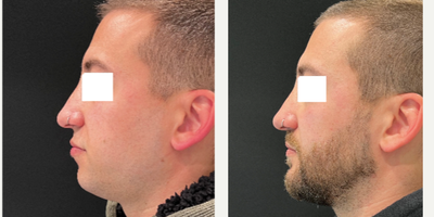 Chin Implant before and after photo