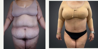 Liposuction before and after photo