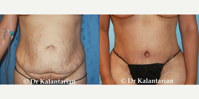 Tummy Tuck before and after photo