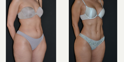 Abdominal Etching before and after photo