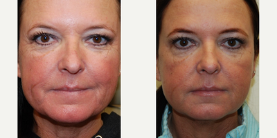 Botox before and after photo