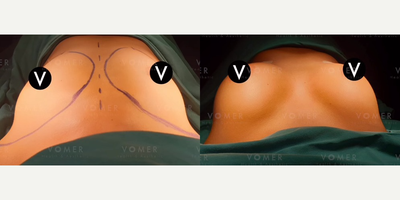 Breast Lift before and after photo