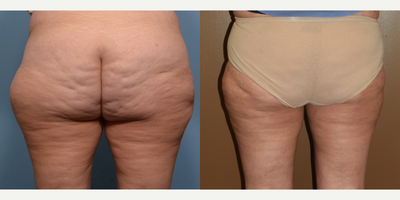 Liposuction before and after photo