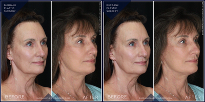 Neck Lift before and after photo