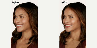 Botox before and after photo