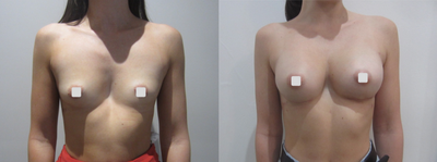 Breast Implants before and after photo