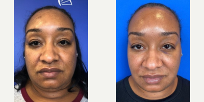 Dermal Fillers before and after photo