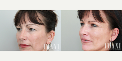 Eyelid Surgery before and after photo