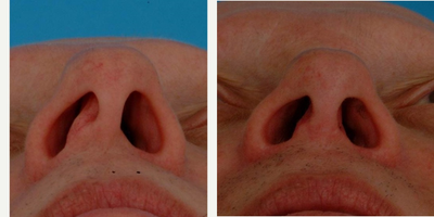 Rhinoplasty before and after photo